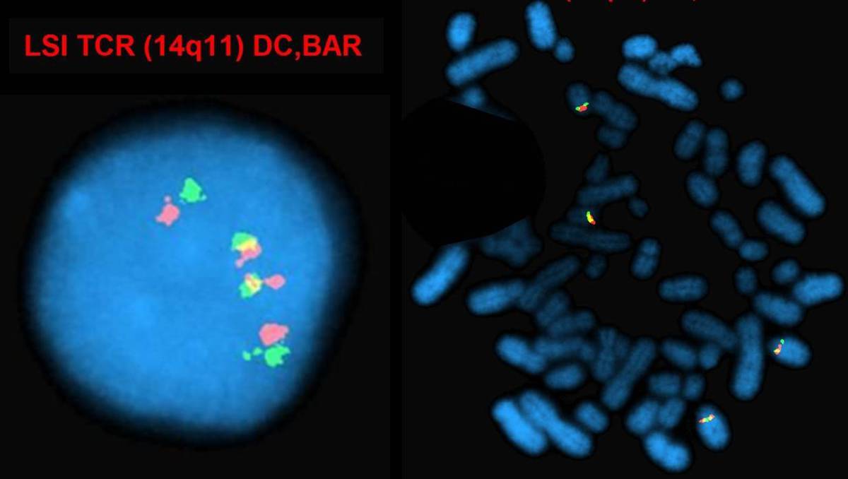 Dual color breakapart probes for 14q11 showing polysomy (+14q)